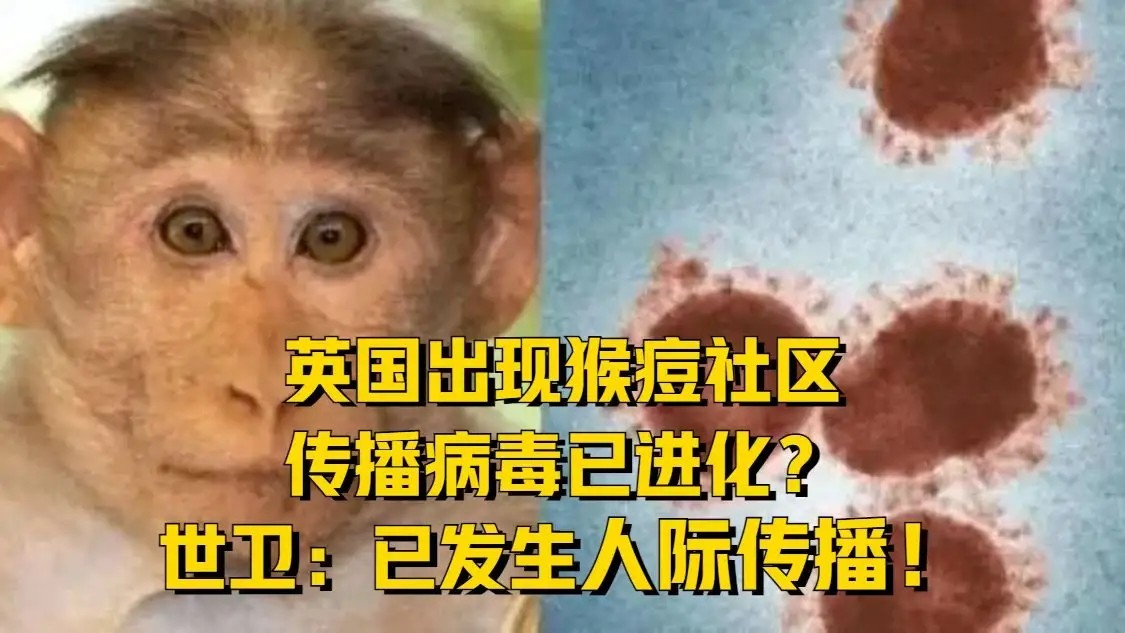 猴痘 猴痘歐洲大規(guī)模傳播 猴痘人際傳播